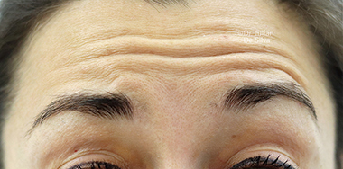 Non-Surgical Treatments Before 13