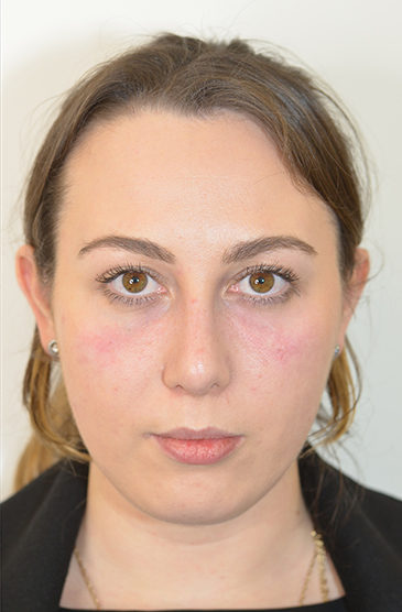 Non-Surgical Treatments After 14