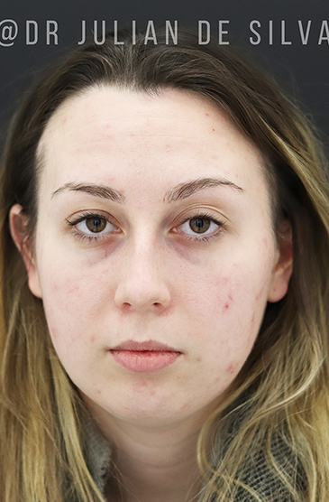 Non-Surgical Treatments Before 14