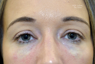 Non-Surgical Treatments After 15