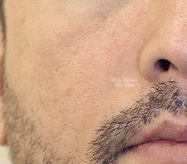 Non-Surgical Treatments After 10