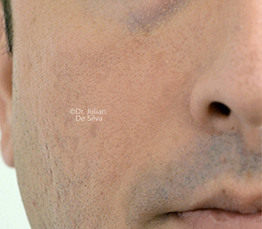 Non-Surgical Treatments Before 10