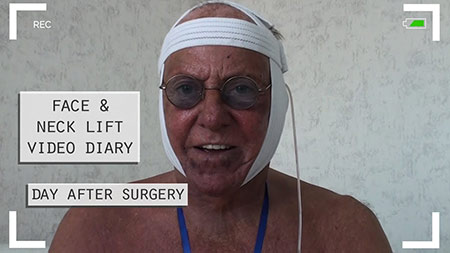 Face and neck lift video diary