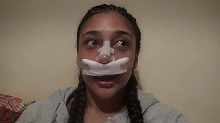 Rhinoplasty Video Diary