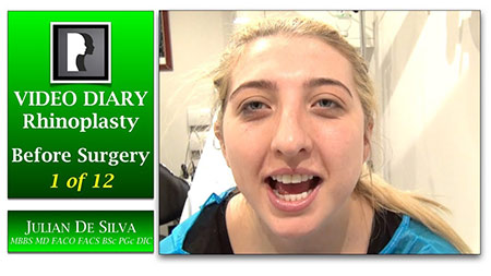 Rhinoplasty Video Diary (VD13)