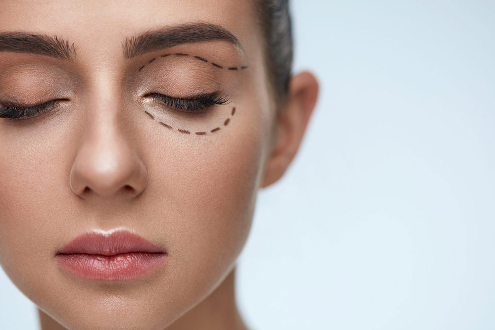 Revision Blepharoplasty