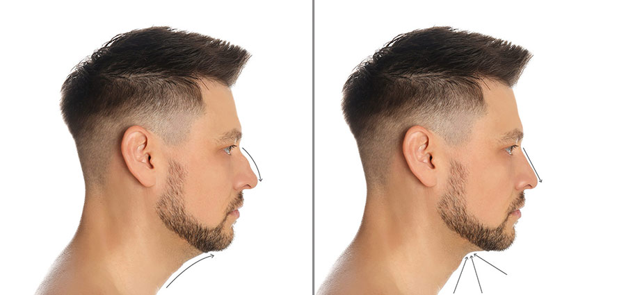 Male Rhinoplasty