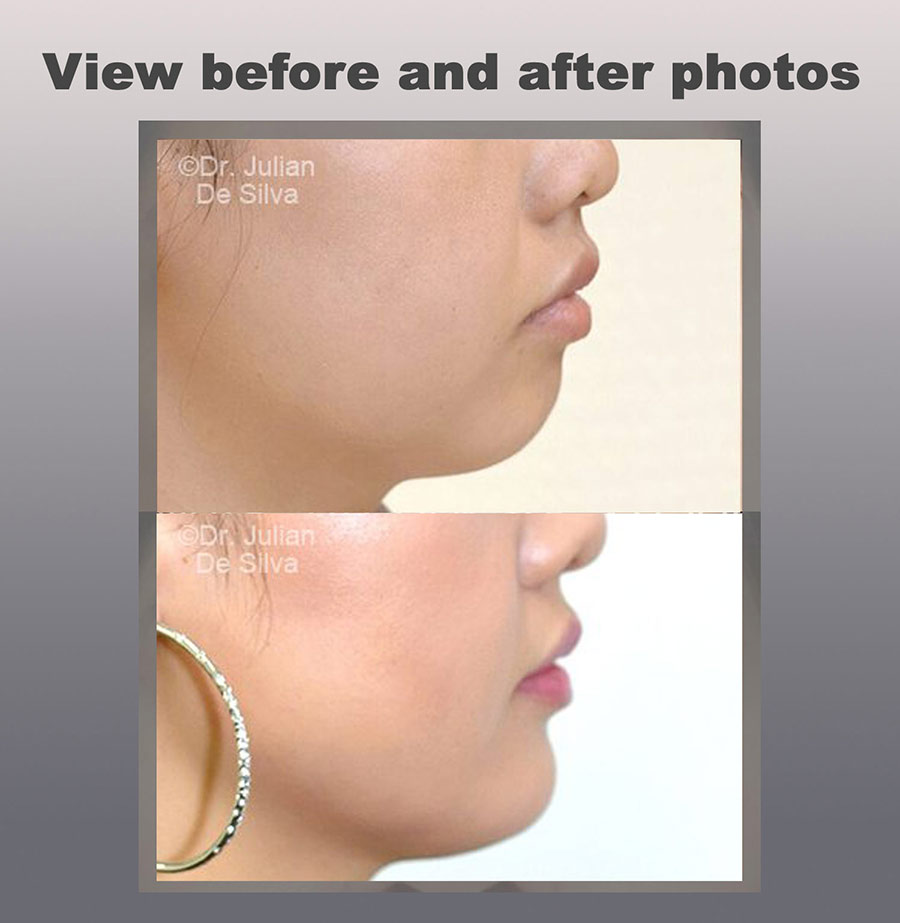 Chin Implants