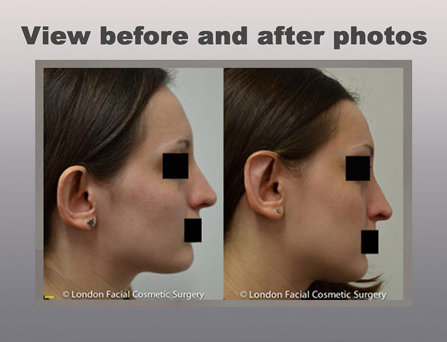 Ear Cosmetic Surgery