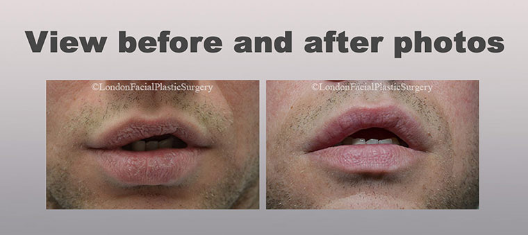 Lip Augmentation (Cheiloplasty)