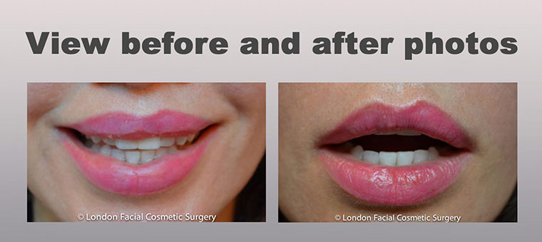 Lip Reduction (Cheiloplasty)