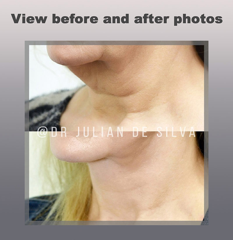 Neck Lift