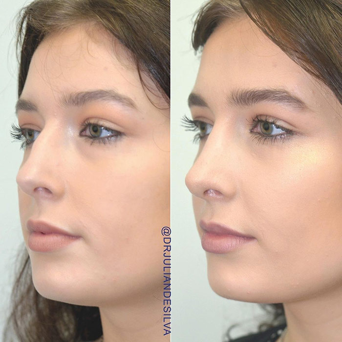 Female face, before and after nose surgery treatment, oblique view, patient 4