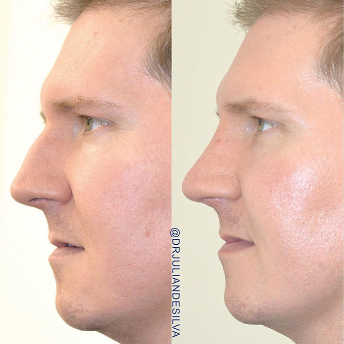 Male face, before and after nose surgery treatment, side view, patient 1