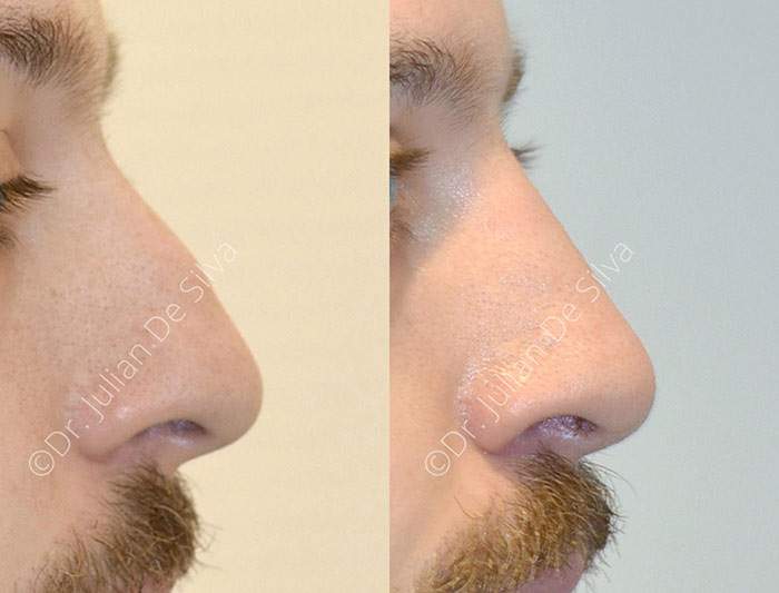 Male face, before and after nose surgery treatment, side view, patient 2