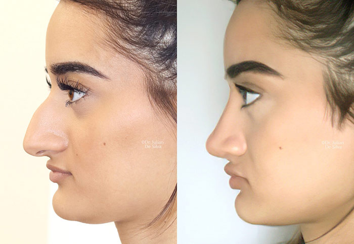 Female face, before and after nose surgery treatment, side view, patient 3