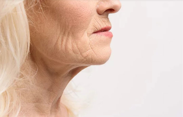 Female neck, side view - What Are the Causes of a Turkey Neck?