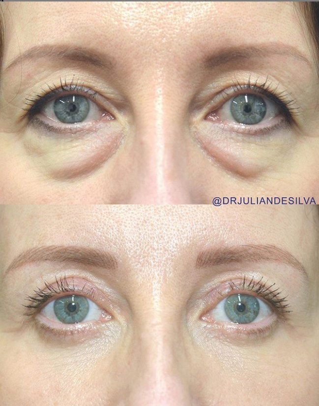 Woman's face, before and after Eye Bag Removal Surgery (Blepharoplasty), front view, patient 2