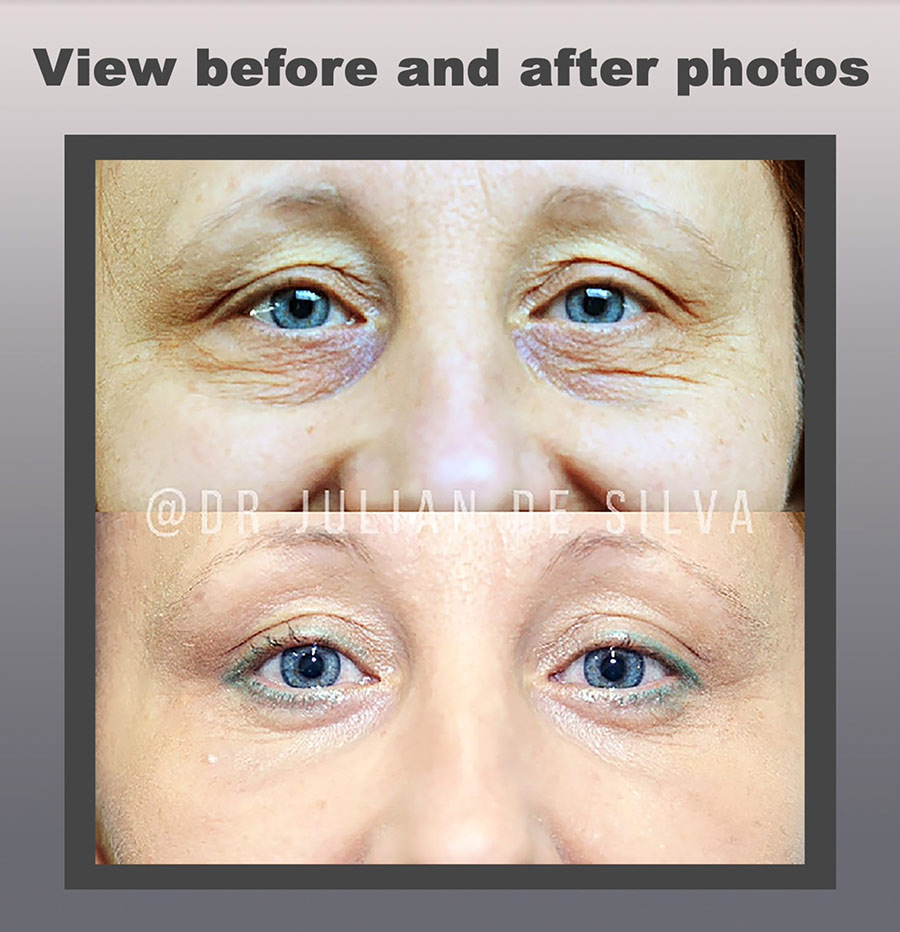 Revision Blepharoplasty