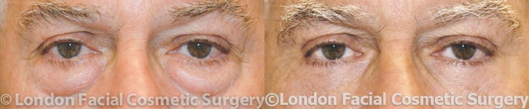 Male eyes, Eyelid Surgery Before and After Photos, front view, patient 2