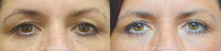 Female eyes, Eyelid Surgery Before and After Photos, front view, patient 3
