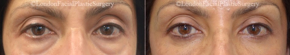 Female eyes, Before and After Eye Lift treatment, front view, patient 7