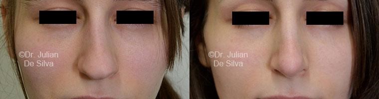 Female face, before and after Nose Jobs treatment, front view, patient 2