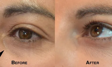 Female eyelid, before and after Blepharoplasty treatment, side view
