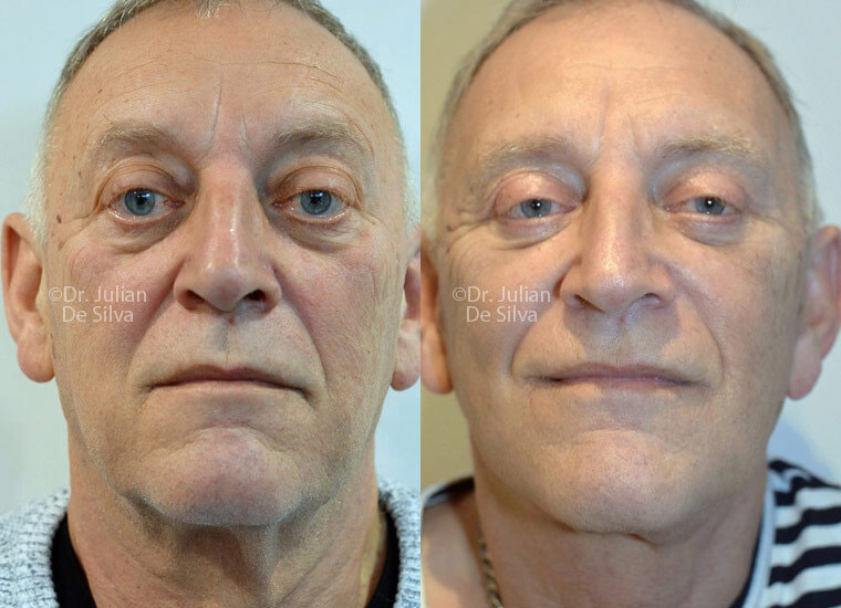 facelift surgery in london before and after3