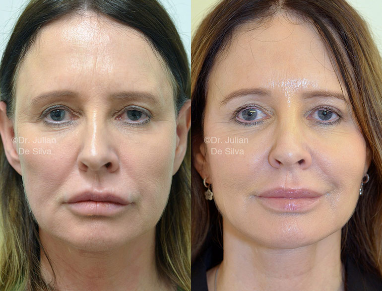 facelift surgery in london before and after