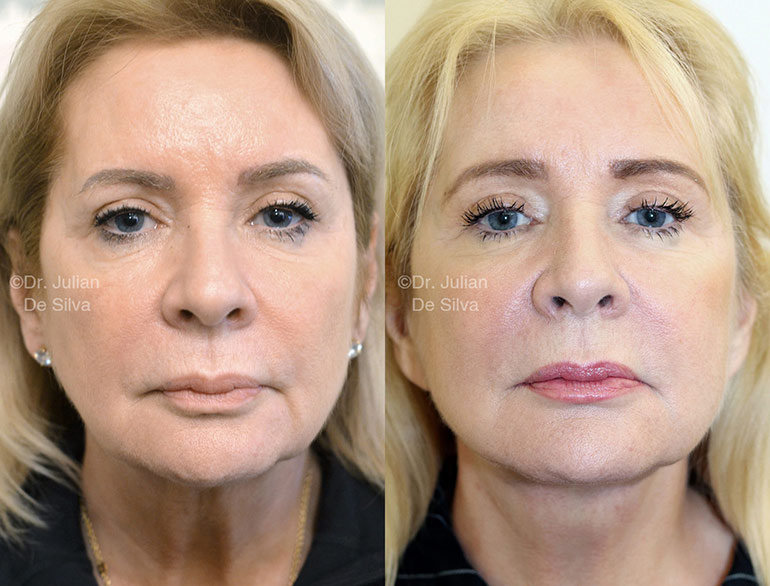 facelift surgery in london before and after 2