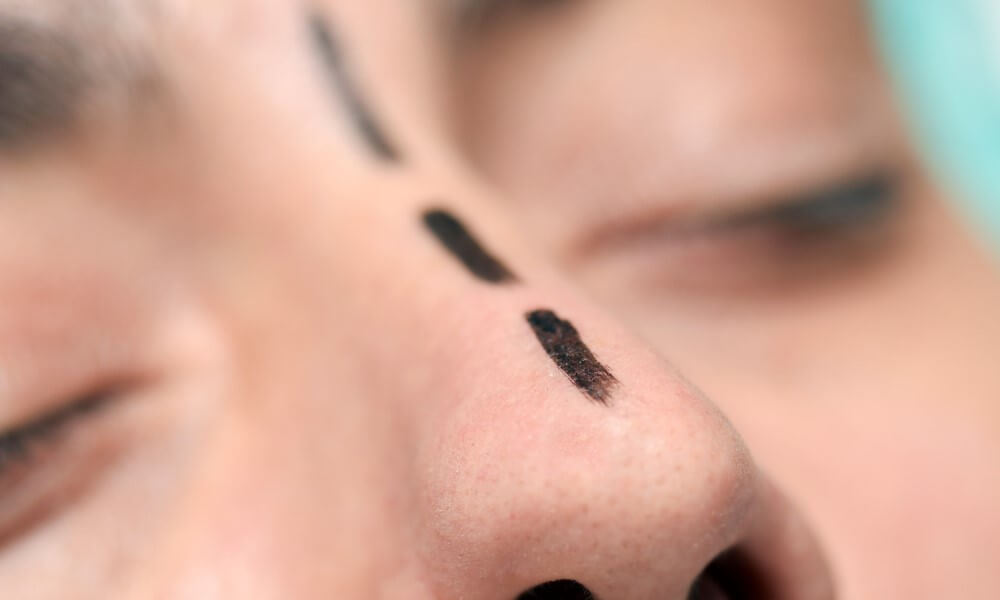 What is nose surgery for men? - pre operation contour on nose