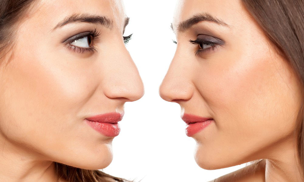 A person with a nasal malformation, hump, or crooked nose may experience low self-esteem.
